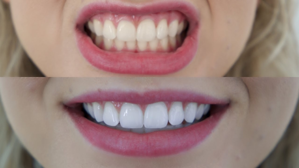 teeth whitening